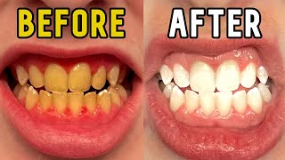 How I Whitened My Teeth in 14 Days [upl. by Enelloc]