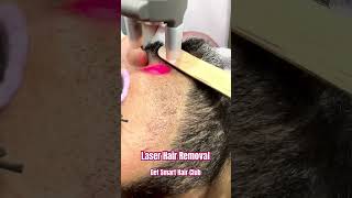 Laser Hair Removal getsmarthairclub laser shorts short shortvideo [upl. by Drageruaeb]