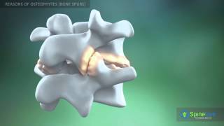 Osteophytes bone spurs Reasons [upl. by Harat696]