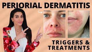 Perioral Dermatitis Triggers amp Treatment Recommendations by a Dermatologist [upl. by Roarke]