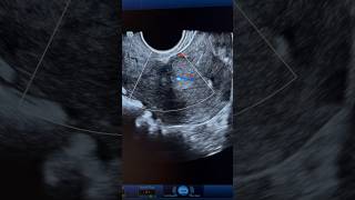 Endometrial Polyp Ultrasound with internal vascularity  ARDMS Sonography  obgyn [upl. by Aimahc]