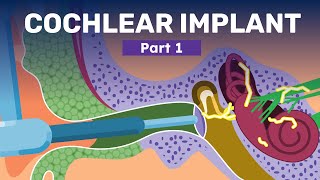 What is A Cochlear Implant  How Hearing Aids and Implants Help Recover Hearing Loss [upl. by Dyan38]