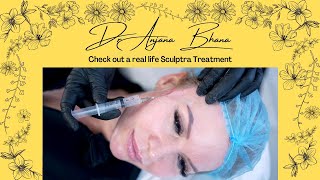 Check out a real life Sculptra treatment [upl. by Affrica]