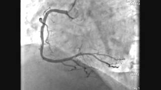 LMCA Stenting Acute MI [upl. by Paehpos633]