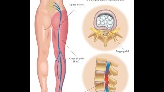 What is Sciatica [upl. by Nospmis886]