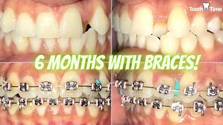 Braces Checkups  6 months progress GREAT Results Tooth Time Family Dentistry New Braunfels Texas [upl. by Lucilla]