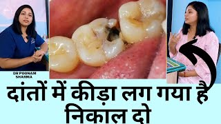 दांतो के कीड़े कैसे निकाले  Dental Cavity Treatment  Dant ke Kide Ka Ilaj In Hindi [upl. by Nahn866]