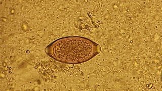 Trichuris trichiura in stool microscopy [upl. by Alasteir]