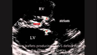 COMPLETE ATRIOVENTRICULAR CANAL IN A DOG wwwveterinaryechocardiographyeuavi [upl. by Qirat]