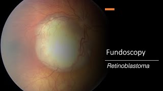 Retinoblastoma Fundoscopy [upl. by Yziar]