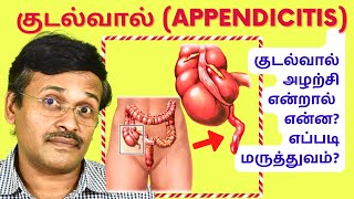 குடல்வால் அழற்சிக்கு ஆபரேஷன் செய்ய வேண்டுமா  appendicitis signs symptoms [upl. by Oicnaneb356]