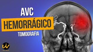 AVC HEMORRÁGICO com Sinais de Hidrocefalia Hipertensiva [upl. by Grayson218]