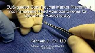 EUS guided Fiducial Marker Placement into Pancreatic head Adenocarcinoma for Cyberknife Radiotherapy [upl. by Anahsat]