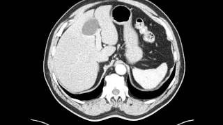 Esophageal leiomyoma distal esophagus  CT [upl. by Sternlight]