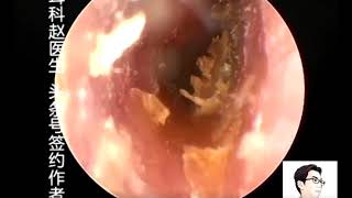 Earwax Removal Extractions Endoscopy Clean Chip Like Earwax Bothside 耳内镜清理干片两例 外耳道挖耳屎清理 耳 [upl. by Ahsenyl169]