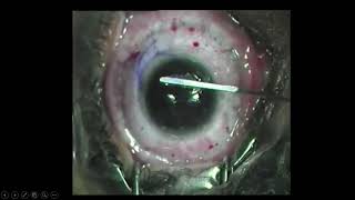 Post LASIK Ectasia  Tackling PostRefractive Surgery Challenges [upl. by Eleazar]