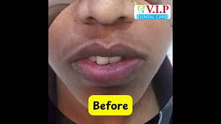 Best fixed orthodontic treatments  VIP DENTAL CLINIC doctor orthodontist [upl. by Saretta]