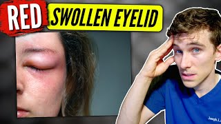 Swollen Eyelid causes amp solutions  Eye Doctor Explains [upl. by Ttayh]