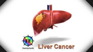 Liver Cancer  Symptom Causes amp Diagnosis Finding Earth [upl. by Riabuz]