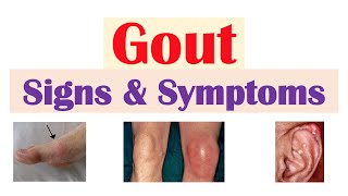 Gout  Mechanisms amp Treatment [upl. by Ikila]