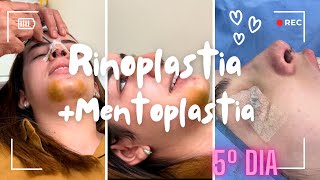 Rinoplastia  Mentoplastia  5º dia com remoção de curativo [upl. by Silsby]