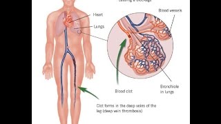 pulmonary embolism treatment [upl. by Ayitahs719]