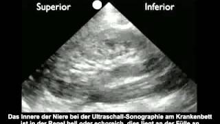 Anleitung Nierenultraschall – Hydronephrose [upl. by Harriot]