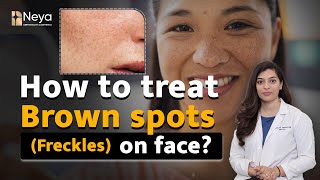 How to minimise Freckles  Dark Brown Spots on Face  Permanent Freckles Treatment [upl. by Buonomo]