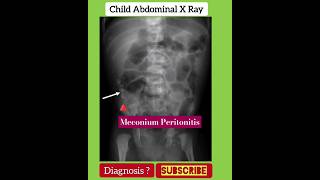 Meconium peritonitis  Diagnosis   Abdominal X RAY  RADIOLOGY [upl. by Christoffer]