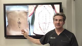 What are the different techniques for repairing the diastasis recti by Dr Iraniha [upl. by Wystand]