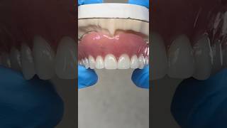 Upper Process Denture EnvisiontecMain envisiontec lsk121shorts dentist teeth [upl. by Eneleoj]