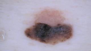 Nevusassociated melanoma  Dr Elvira Moscarella [upl. by Adohr]