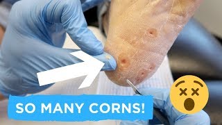 SUPER SATISFYING CORN REMOVAL [upl. by Eusoj]