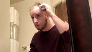 BALDING YOUNG  GOING BALD Shaving My Head From Now On  LIVE 13 [upl. by Kinny177]