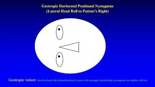 Geotropic and Apogeotropic Horizontal Positional Nystagmus [upl. by Franza]