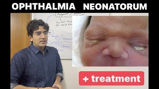 Ophthalmia Neonatorum Clinical features and Treatment [upl. by Debi]