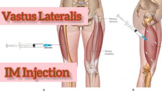 IM Injection Technique In Vastus Lateralis In Bangla । উরুতে IM ইনজেকশন টেকনিক  Trust Medical [upl. by Dera]