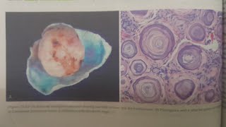 Meningioma  SPECIAL PATHOLOGY [upl. by Naginnarb]