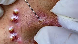 Big Cystic Acne Blackheads Extraction Blackheads amp Milia Whiteheads Removal Pimple Popping [upl. by Ycrad506]