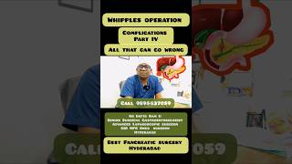 Whipples operation part IV complications best Pancreatic surgeon [upl. by Animor]