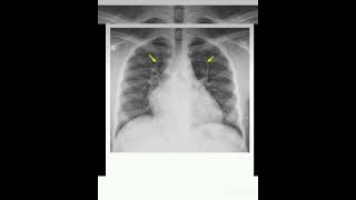 antlers sign mitral stenosis medicose radiology⛑️🩺✨🏥🏥 Sudarshanlipane177 [upl. by Ralyat]