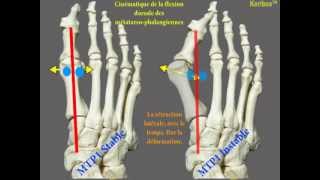 Instabilité de la première métatarsophalangienne dans lhallux valgus [upl. by Asyal]