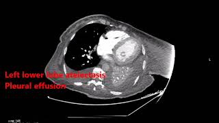 Lung Ultrasound Atelectasis Pleural effusion [upl. by Nancy]