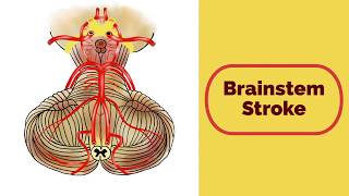 Brainstem Stroke Syndromes [upl. by Aihseyt]