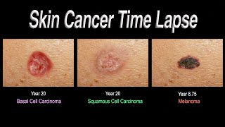 Skin Cancer Time Lapse Basal Cell Carcinoma Squamous Cell Carcinoma Melanoma [upl. by Newnorb69]