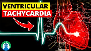 Ventricular Tachycardia Vtach  Medical Explainer Video [upl. by Alphonse]