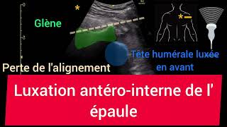 Luxation antérointerne de lépaule Glénohumérale Échographie [upl. by Aicnatsnoc]