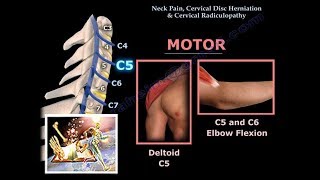 Neck Pain Cervical Disc Herniation amp RadiculopathyEverything You Need To Know  Dr Nabil Ebraheim [upl. by Mahmoud]