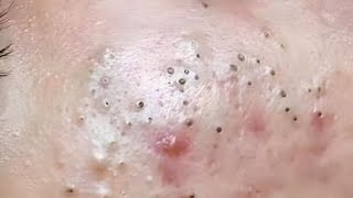 New Blackheads ​⁠BYoungSpa here [upl. by Nhepets]