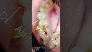 Single Visit Endodontic Treatment الكربولة endodontics dental [upl. by Ydisahc916]